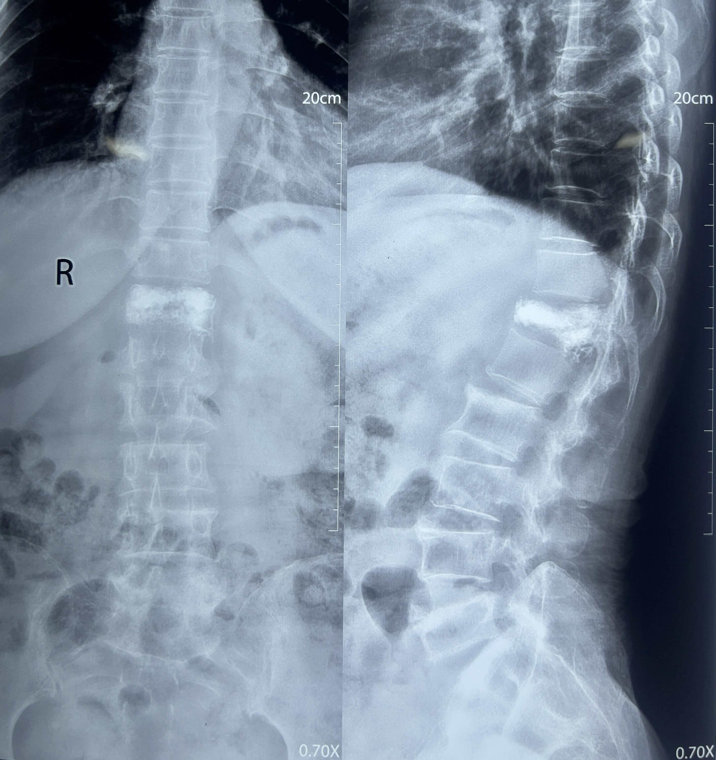 मेरुदण्डको हड्डी कमजोर भएर भाँचिएने: सुई बाट इलाज संभव छ!